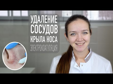 Удаление сосудистой сетки на лице | косметология Самара