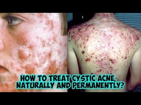 Cystic Acne | How to treat cystic acne, naturally and permanently? -Healthy Wealthy