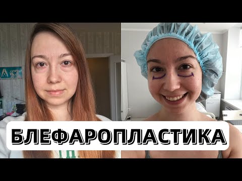 Блефаропластика. Как я избавилась от мешков и отеков под глазами.