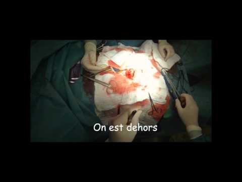 Video: Anastomosis I - Verklarende Medische Termen
