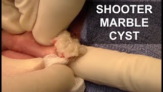 Shooter Marble Cyst in Lip | Dr. Derm