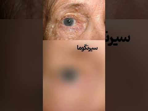 تفاوت میلیا و غدد چربی زیرچشم