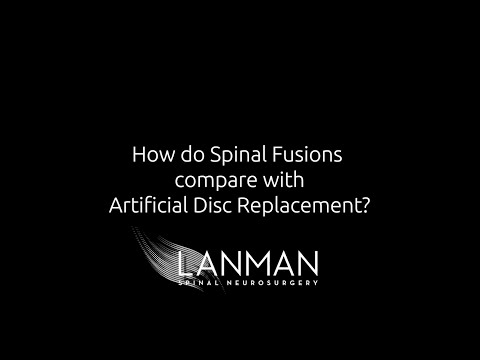 Artificial Disc Replacement vs. Spinal Fusion: Comparison | Dr. Todd Lanman