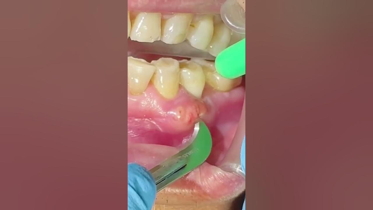 Painless Dental Abscess Drainage Techniques and Best Practices YouTube