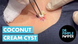 A Coconut Cream Cyst on the Chest 🥥🥥