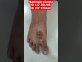 Nummular eczema01647-386185 ||01727-375664