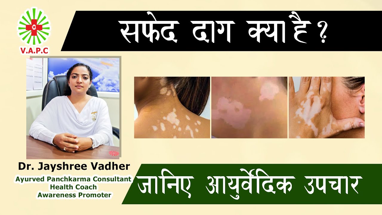 Safed Daag Kya Hai? I Janiye Ayurvedic Upchaar I Vitiligo Ayurvedic