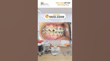 Hành trình LỘT XÁC nhờ niềng răng của Ngọc Hiếu