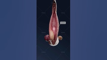 What turns a Bartholin cyst into a painful abscess? Study gynecology in 3D with VOKA