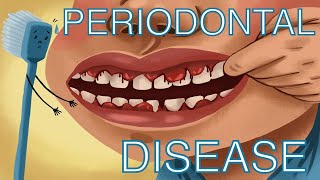Periodontal Disease
