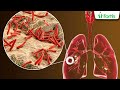 Understanding TB for a Healthier Tomorrow