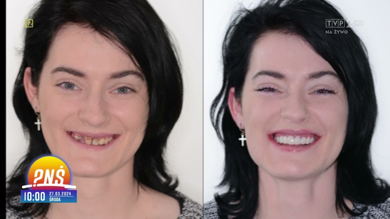2024-03-27 NIESAMOWITA METAMORFOZA PANI WIKTORII | TRZECIE ZĘBY NA IMPLANTACH W JEDEN DZIEŃ!