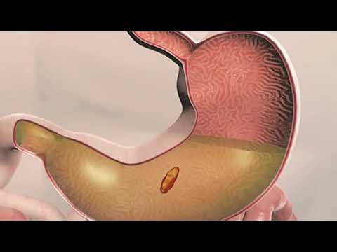 Vidéo: Diverticule De Meckel: Symptômes, Diagnostic Et Traitements