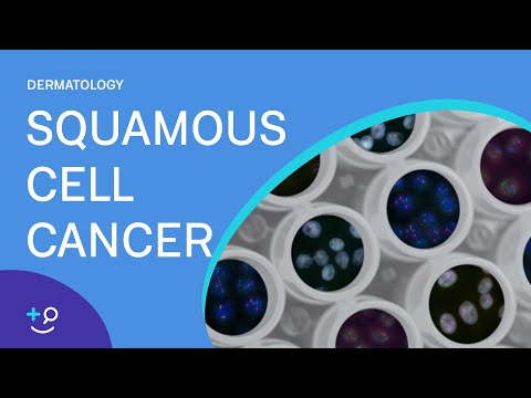 Video: Puas squamous cell carcinoma mob?