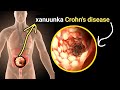 Xanuunkaan Crohn S Disease Maahan Gaas Iyo Tiifoow Balse Waxaa Lisku Qaldaa Calaamadaha Kala Baro Xanuunkaan Crohn S Disease Maahan Gaas Iyo Tiifoow Balse Waxaa Lisku Qaldaa Calaamadaha Kala Baro