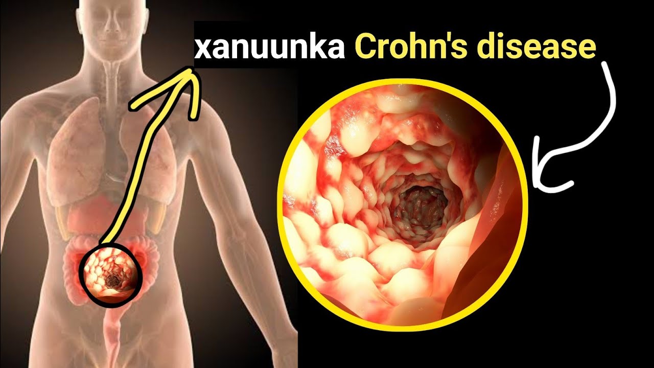 Xanuunkaan Crohn's disease maahan Gaas iyo Tiifoow balse waxaa lisku qaldaa calaamadaha kala baro