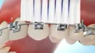 چگونگی مسواک زدن براکت ها در ارتودنسی