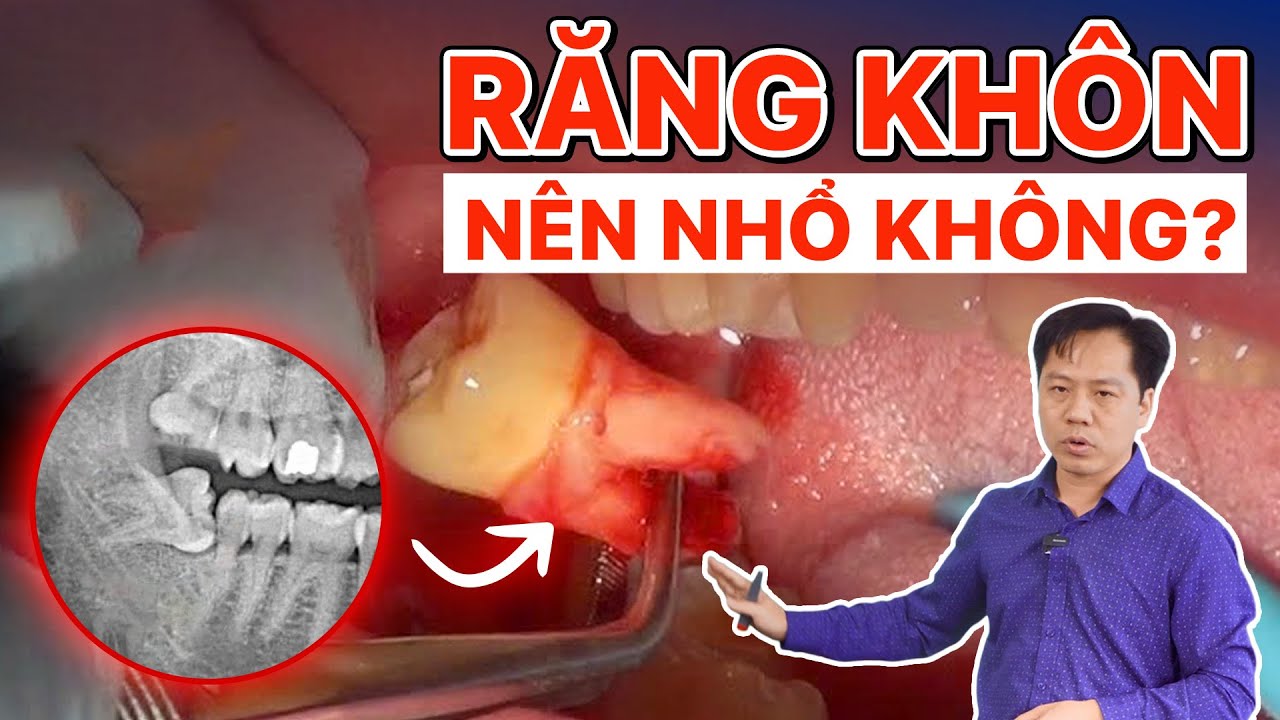 Có Nên Nhổ Răng Khôn Không?  Khi Nào CẦN NHỔ, Khi Nào CÓ THỂ GIỮ LẠI? Nha Khoa Lạc Việt Intech