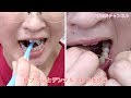 【青森_十和田市_歯医者】舌の口内炎をすぐ治す方法！_さつき歯科チャンネル031（口腔ケアチャンネル）
