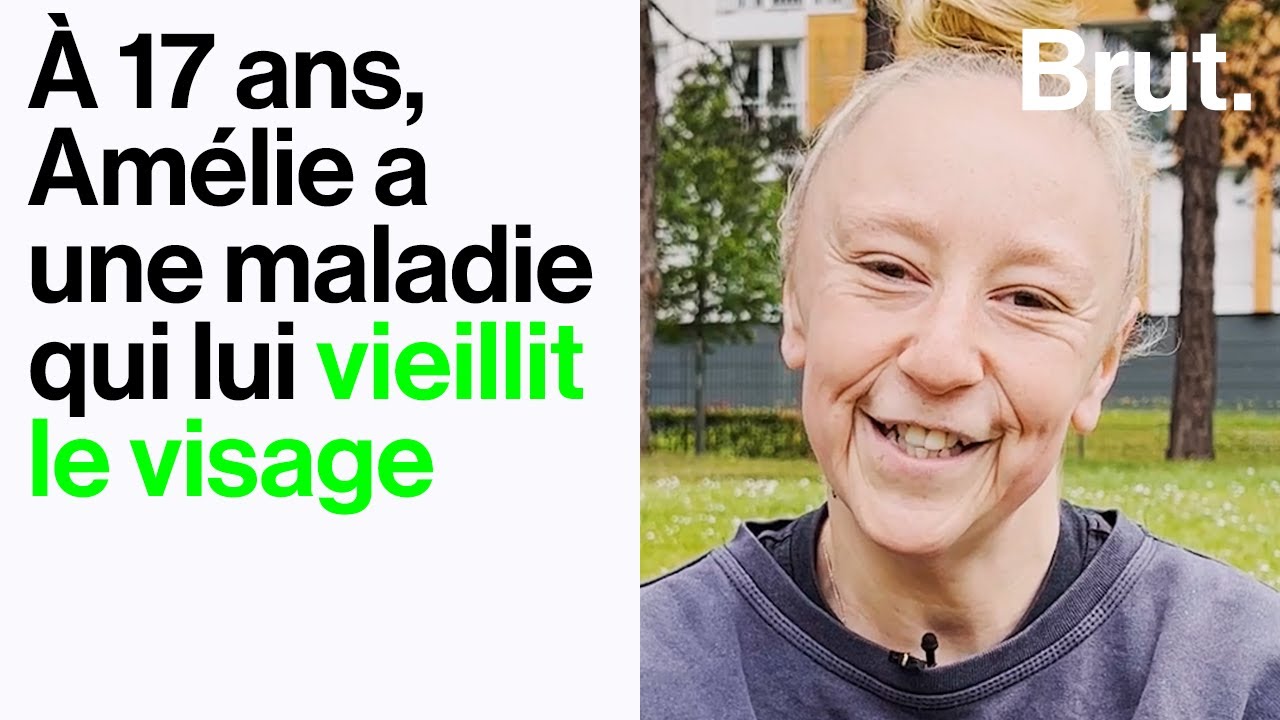 Amélie, 17 ans, atteinte d'une maladie qui lui vieillit le visage