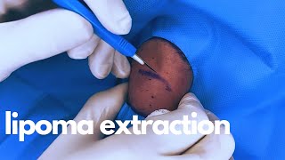 LIPOMA EXTRACTION | CONTOUR DERMATOLOGY