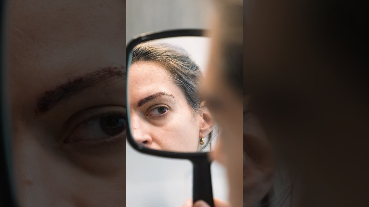 Eyebrow Transplant Client Testimonial - Before & After - Dr. John Frank Hair Clinics