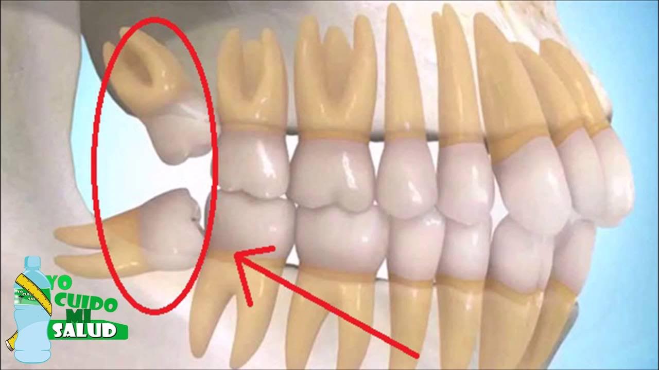 Полная адентия верхней челюсти. Полная адентия верхней челюсти. Полная адентия верхней челюсти. Поднять верхний зуб. Полуретинированный зуб мудрости.