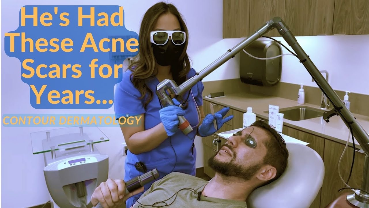 Полная демонстрация использования эрбиевого лазера для удаления рубцов от угревой сыпи у мужчин!