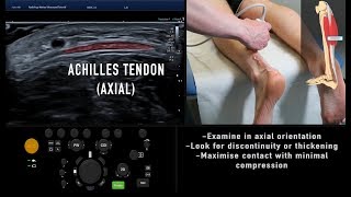 Ultrasound Tutorial: MSK Series: Achilles Tendon | Radiology Nation screenshot 2