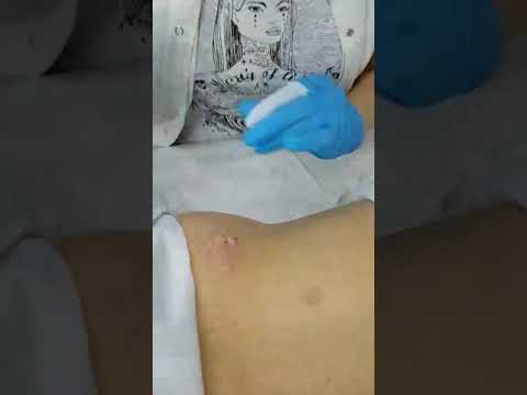 Big acne big cyst big hair absces ogromna bubuljica