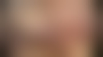 Cắt túi mật nội soi tiêu chuẩn CVS