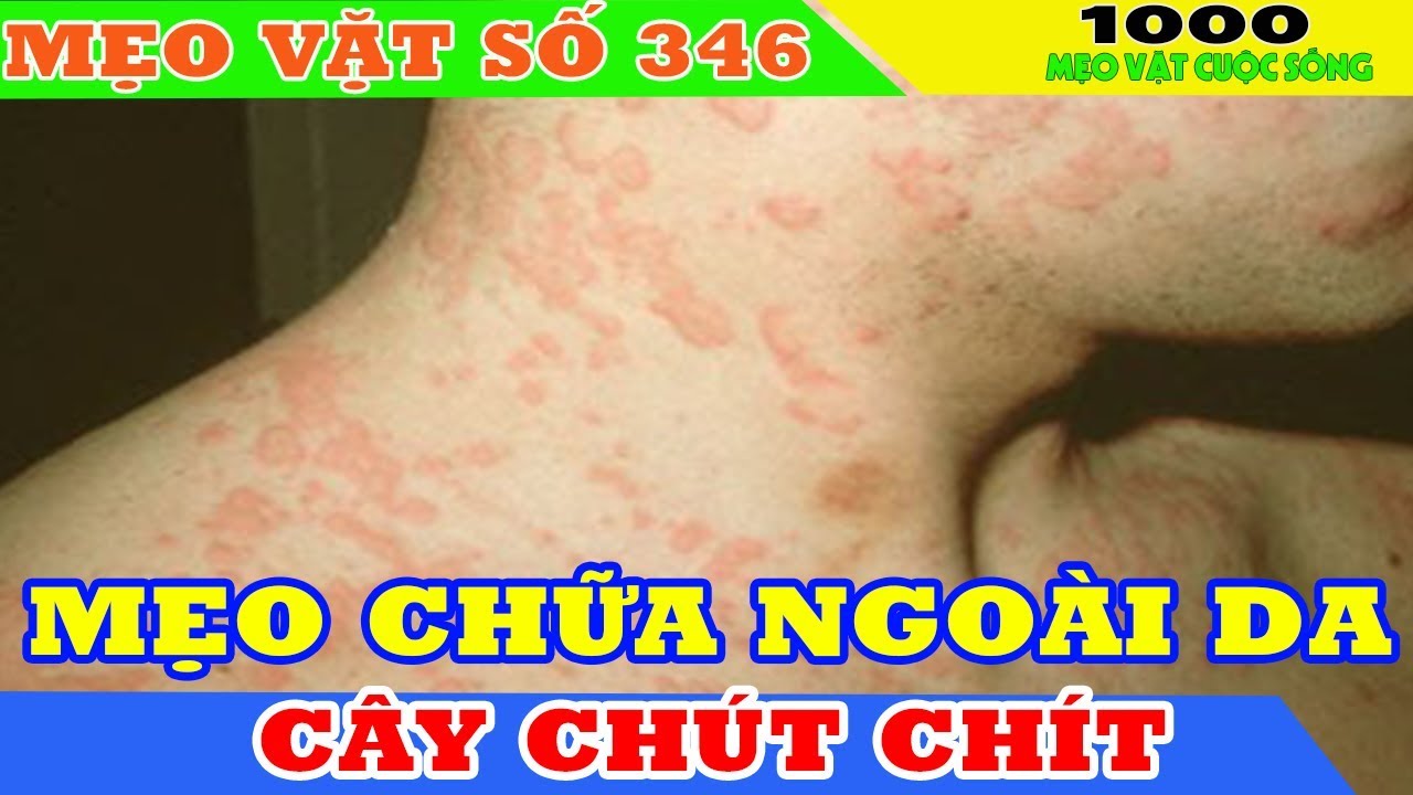 Mẹo chữa các loại bệnh ngoài da từ cây chút chít II Chữa viêm da cơ địa tại nhà