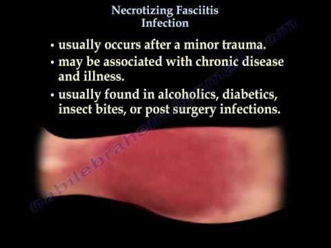 Necrotizing Fasciitis - Таны мэдэх ёстой бүх зүйл - Доктор Набил Эбрахейм