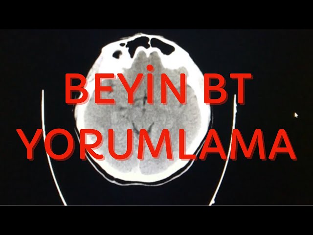 BEYİN BT NASIL OKUNUR? ÖRNEK VAKALARLA BEYİN BT YORUMLAMA class=