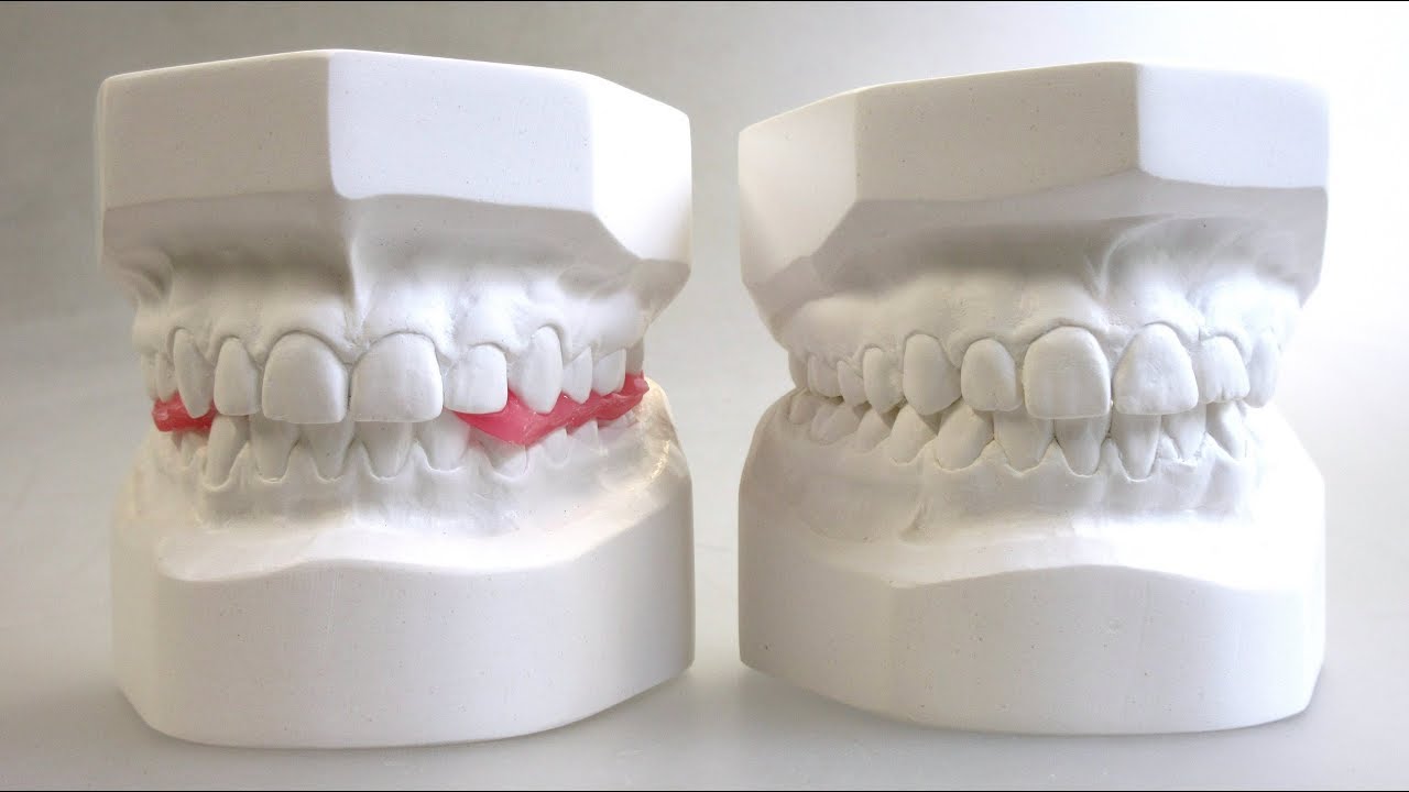 DiagnostikModelle KFO Trimmen, Orthodontic Study Models Trimming YouTube