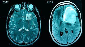 ¿Afectan los tumores cerebrales al comportamiento?