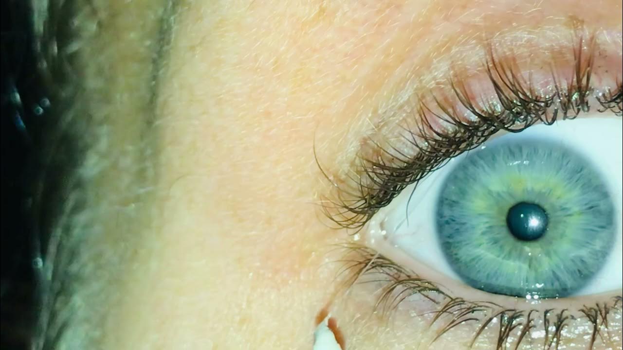 Eye mucous fishing syndrome YouTube