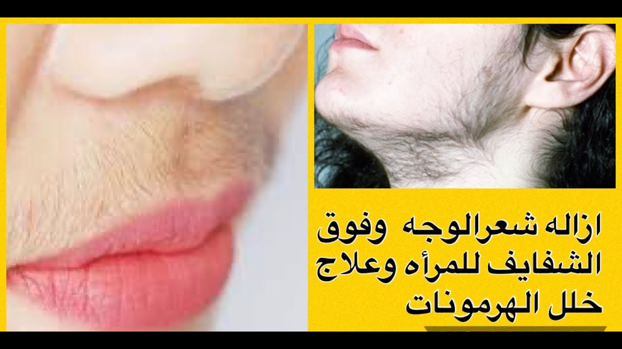 Удаление волос на лице и предотвращение роста волос/синдром поликистозных яичников/избыток мужски...