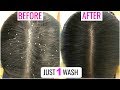 Apply this Once & Get Rid Of Dandruff/Itchy Scalp | Anaysa