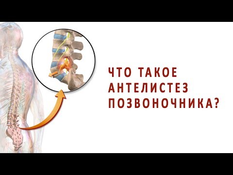 Что такое антелистез позвоночника?