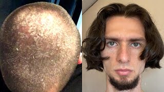 How I cured my dandruff (3 tips)