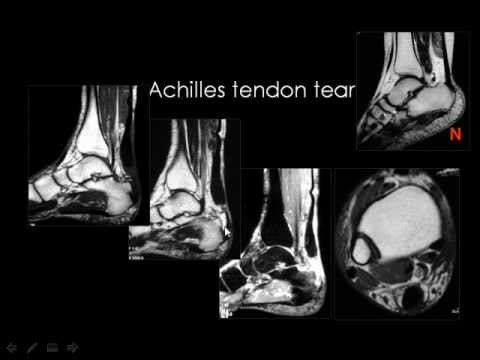Radiology - Imaging of the Ankle Joint - Lower Limb - YouTube