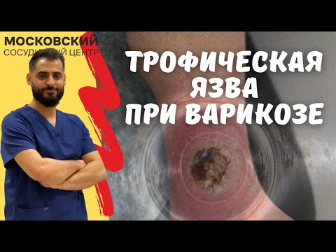 Трофическая язва при варикозе (клинический случай часть 1)