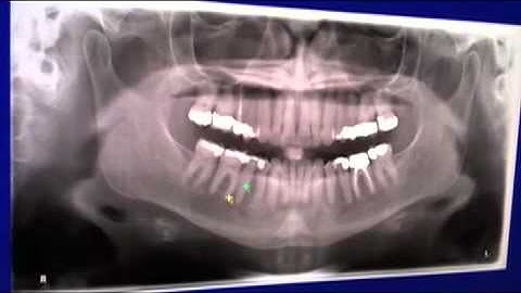 CBCT Scan using Veraviewepocs 3De