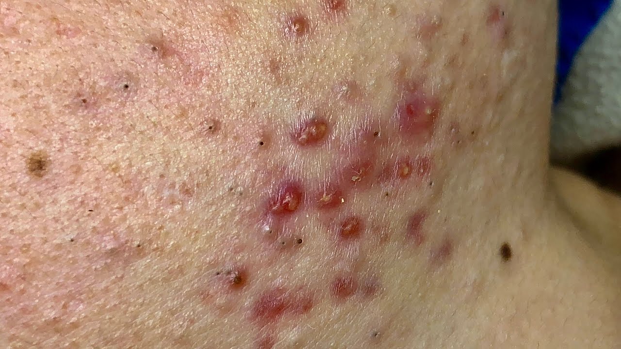 Let's see how to get blackheads #62