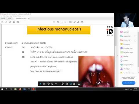 Mini lecture 26 Case demonstration Infectious mononucleosis