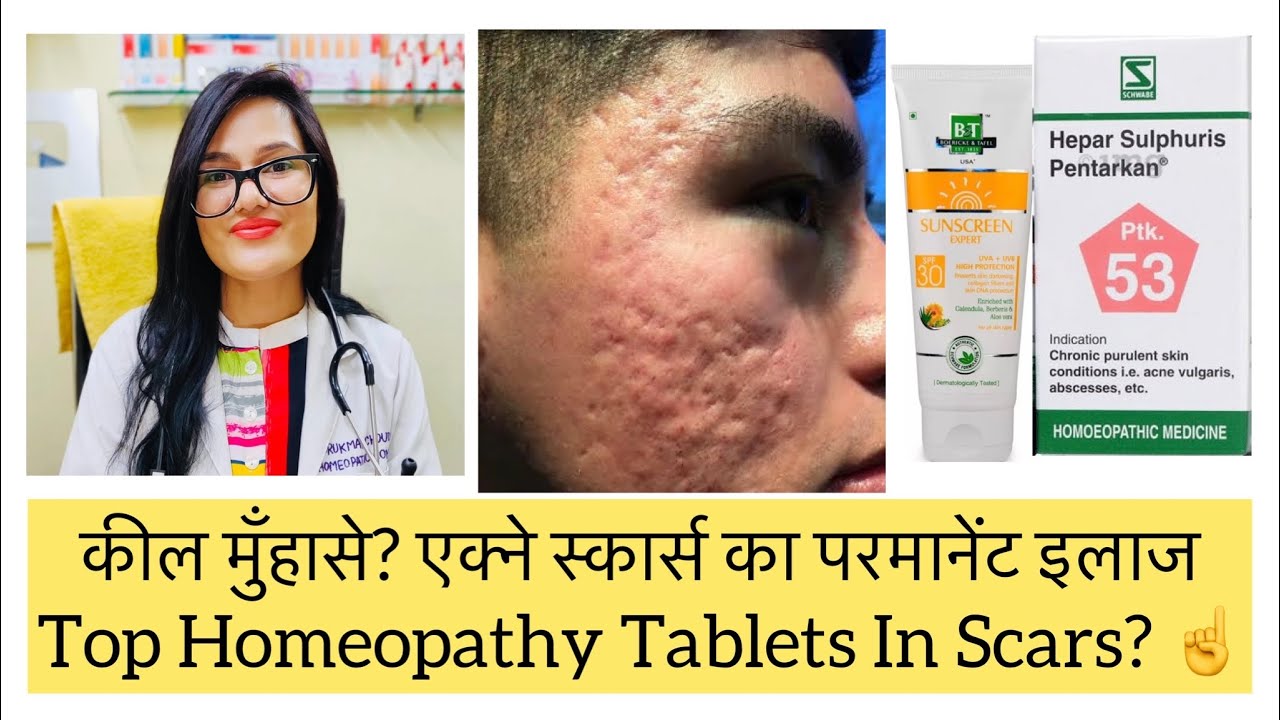 ??????????????? ??????????????? ?????? ???????????????????????? ????????????? Acne Scar Best Homeopathic Medicine