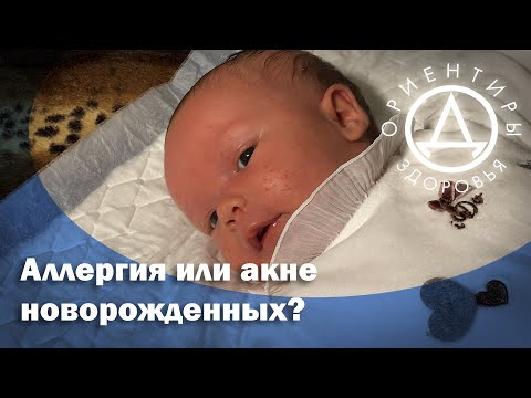 Аллергия или акне новорожденных?