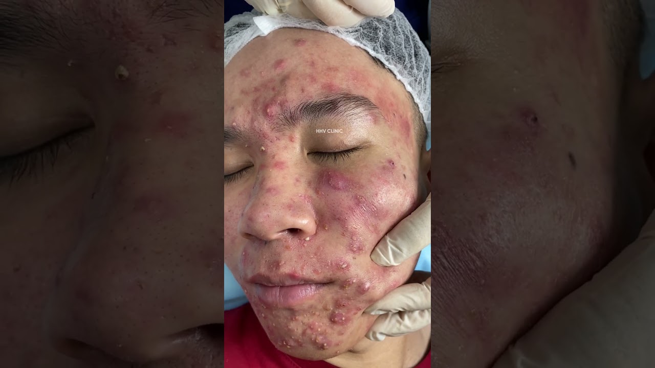 Mụn viêm nặng lan mặt bài học cho ai đang tự trị mụn.