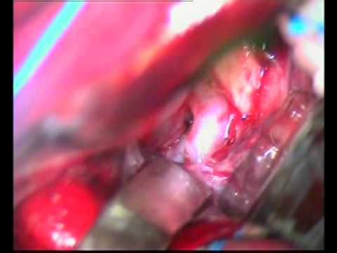 Brain Aneurysm (PCoA) Surgery, Aneurisma Cerebral (Thrace-Greece)